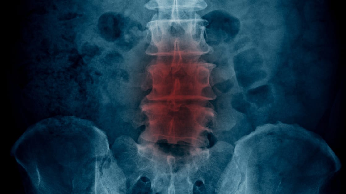 estenose-coluna-vertebral
