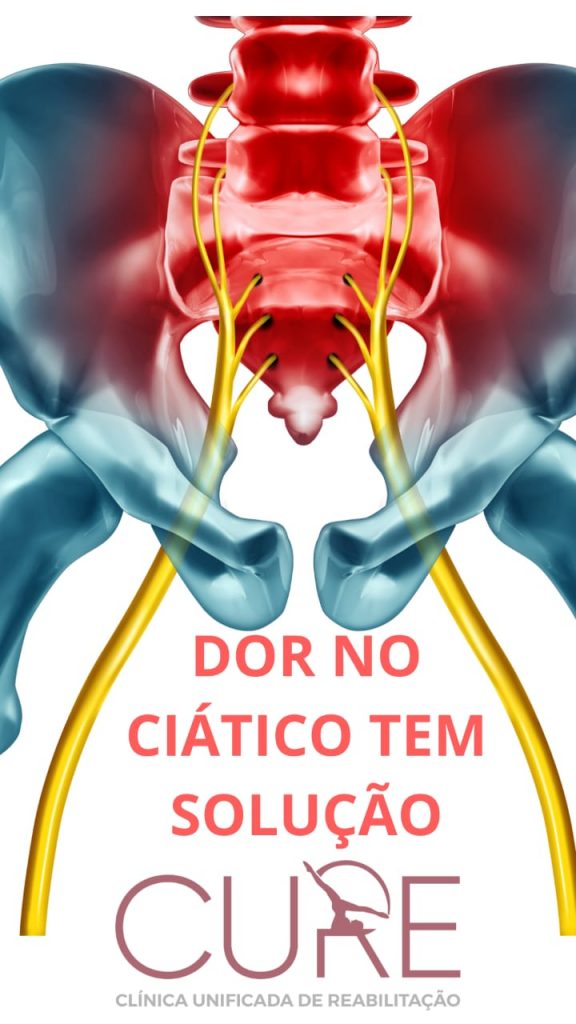 Ciatalgia: a Dor no Nervo Ciático